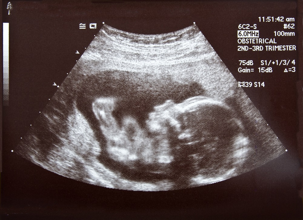 Using an ultrasound machine, millions of high-frequency ultrasonic sound waves are transmitted into the human body—and the reflections, or echoes, they send back are used to see what’s going on inside. Ultrasound is commonly used to look at how fetuses are doing inside their mother’s wombs. This is a picture of an ultrasound done when the fetus is 17 weeks old. (Darren Brode/ Shutterstock) 